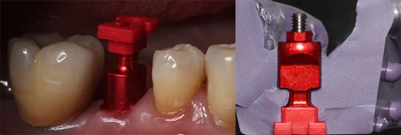 Informative oral care related imagery with a file name of Root-canal-treatment_12.jpg shown on Solventum's "Brain Floss" blog