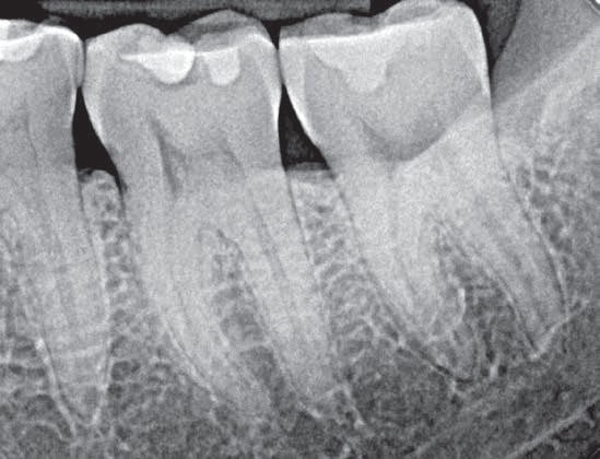 Informative oral care related imagery with a file name of Gueth3unitZirconia_Story10.jpg shown on Solventum's "Brain Floss" blog