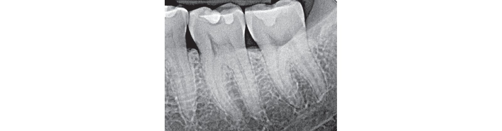 Informative oral care related imagery with a file name of Gueth3unitZirconia_Story10.jpg shown on Solventum's "Brain Floss" blog