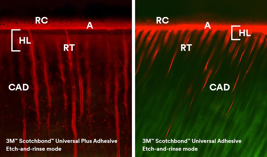 Informative oral care related imagery with a file name of Root-canal-treatment_2.jpg shown on Solventum's "Brain Floss" blog