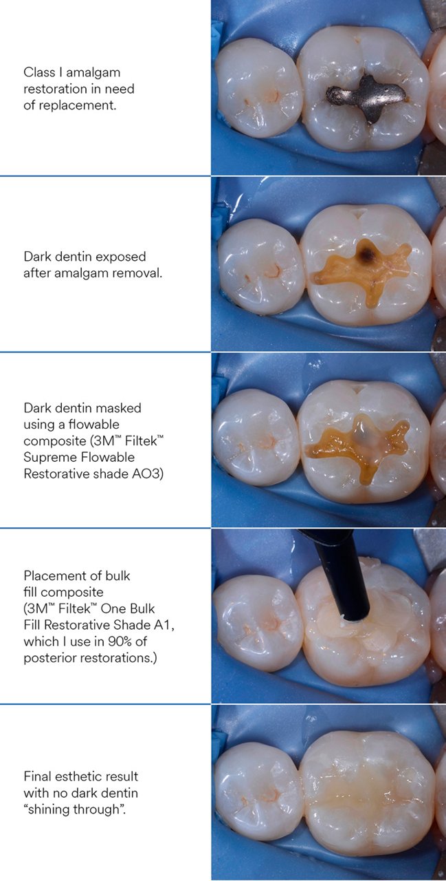 Informative oral care related imagery with a file name of Gueth3unitZirconia_Story9.jpg shown on Solventum's "Brain Floss" blog