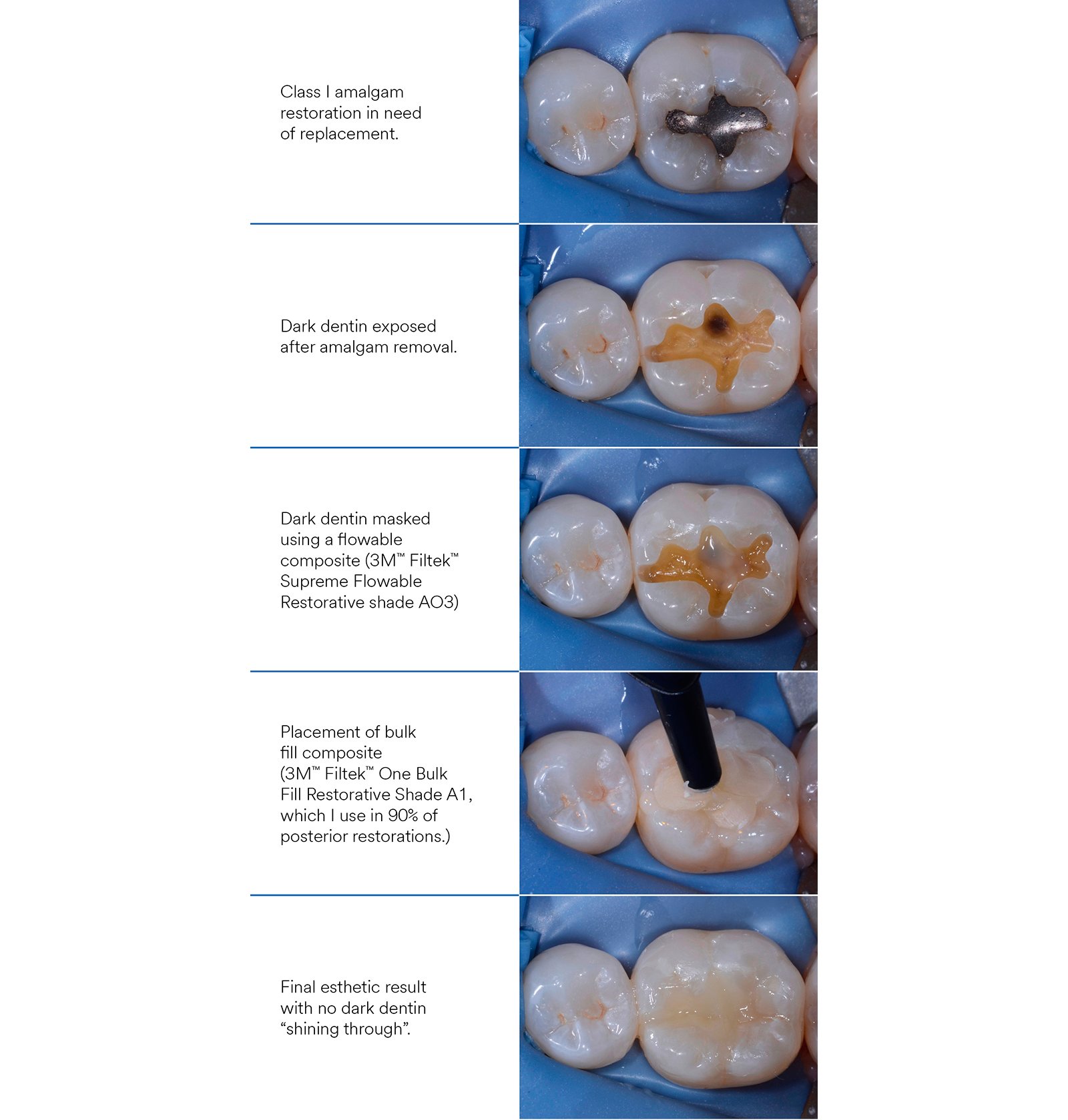 Informative oral care related imagery with a file name of Gueth3unitZirconia_Story9.jpg shown on Solventum's "Brain Floss" blog