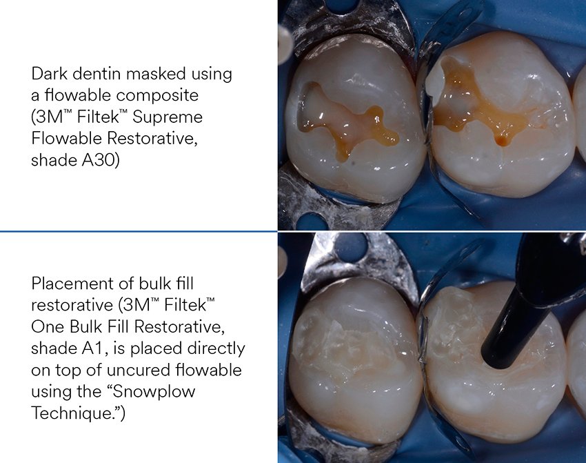 Informative oral care related imagery with a file name of CC_14_Weston_Posterior_560x400_5.jpg shown on Solventum's "Brain Floss" blog