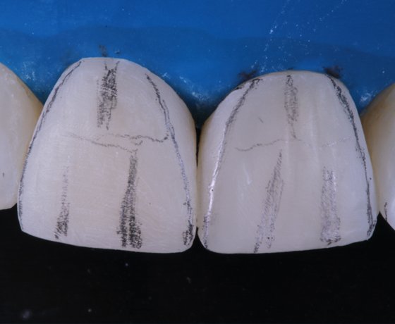 Application of adhesive