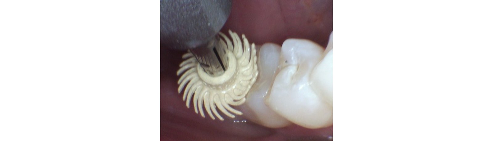3M™ Sof-Lex™ Pre-Polishing Spirals (Beige)