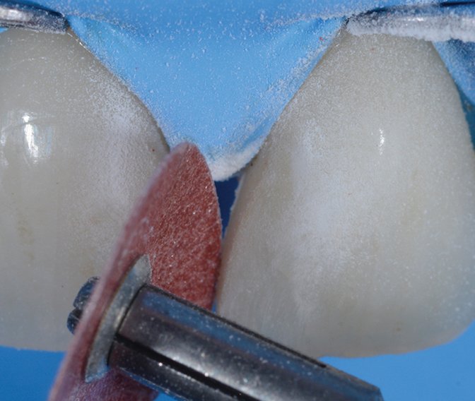 Contouring and polishing discs roughen the surfaces