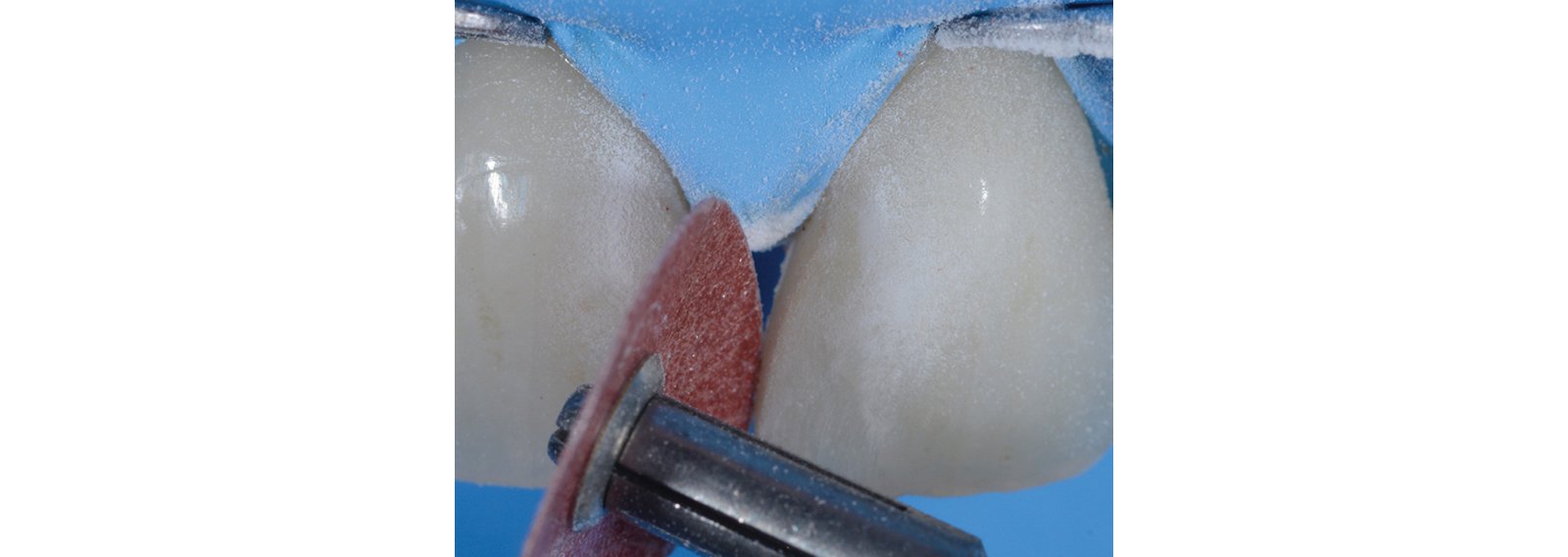 Contouring and polishing discs roughen the surfaces
