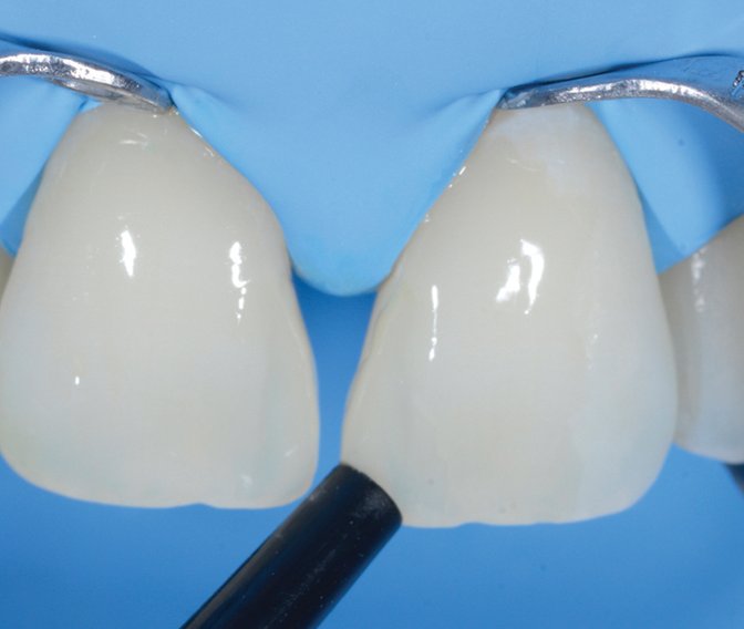 Restorative placed