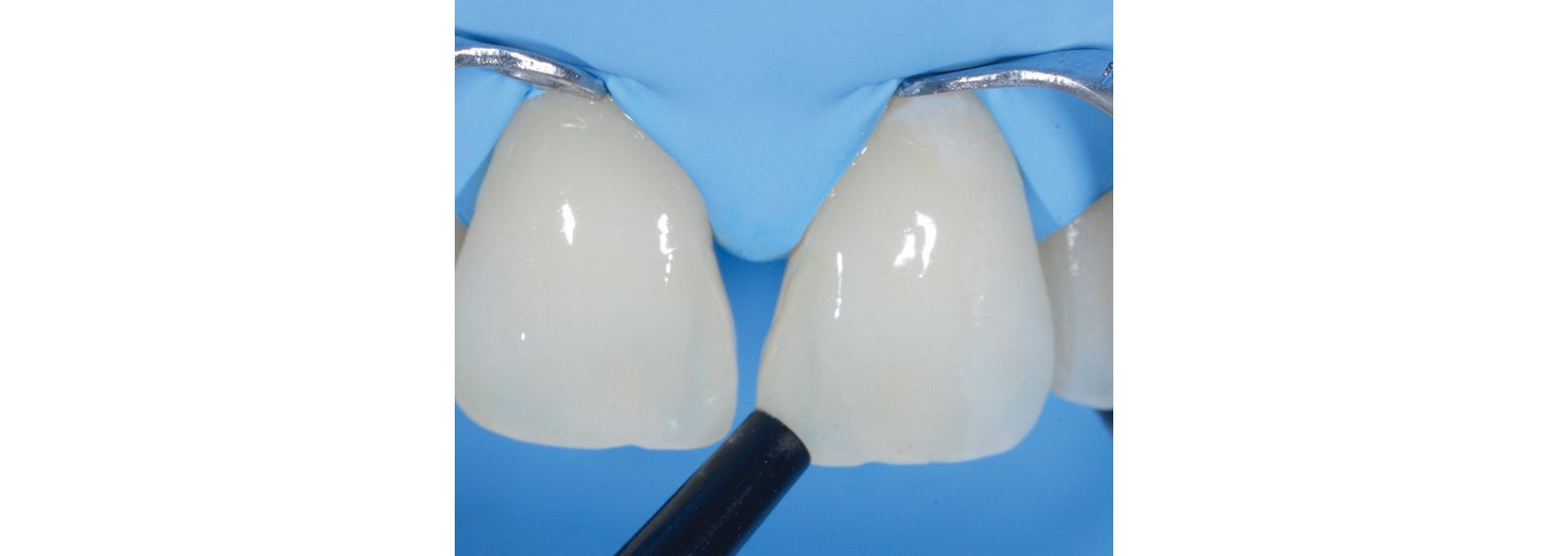 Restorative placed