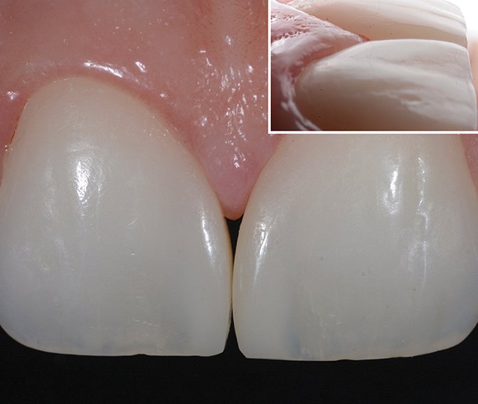 Composite blended well with natural surface of central incisors