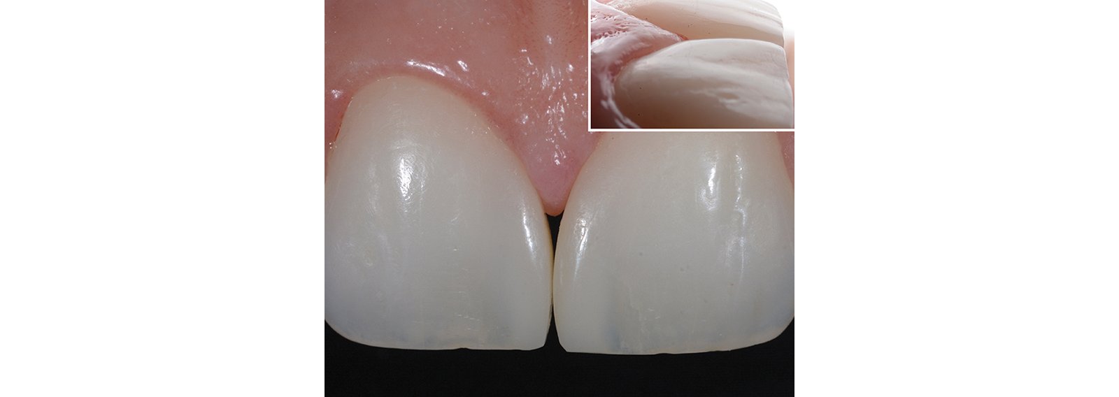 Composite blended well with natural surface of central incisors