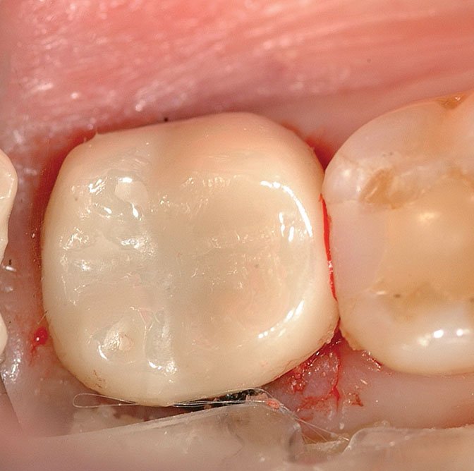 Post cementation cleanup