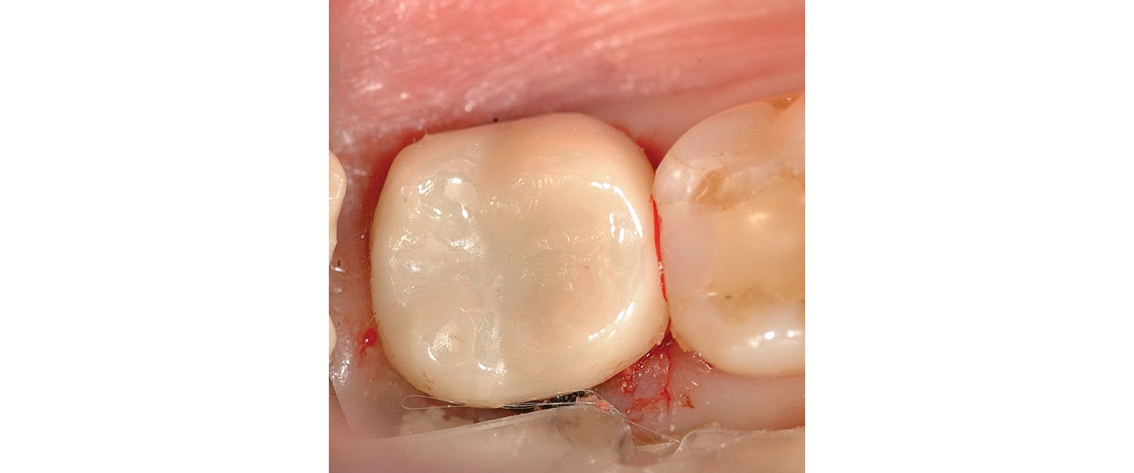 Post cementation cleanup