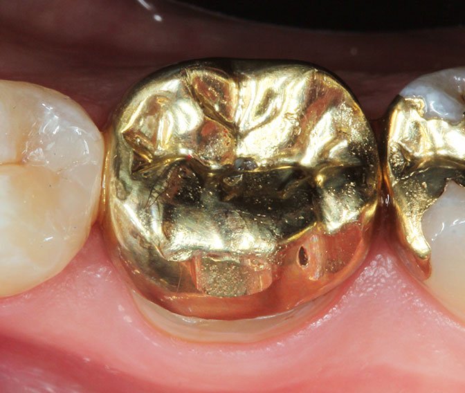 Insufficient gold alloy partial cast crown on lower molar #46