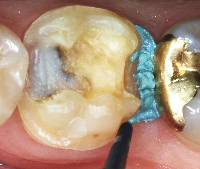 Minimal preparation and moisture control using retraction paste