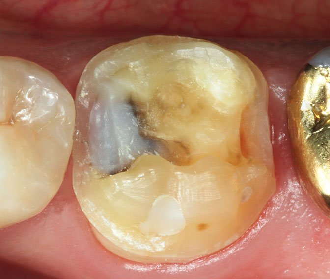 Dry operative field prior to impression taking