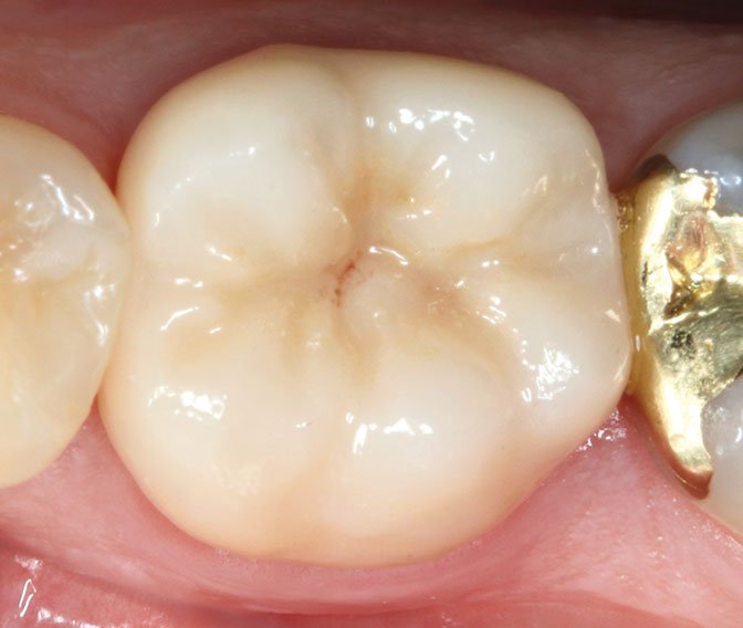 Final cemented all-ceramic partial crown