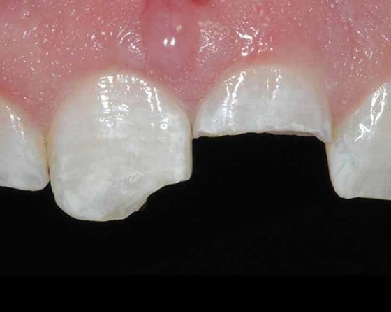 Class IV fractures of the maxillary central incisors