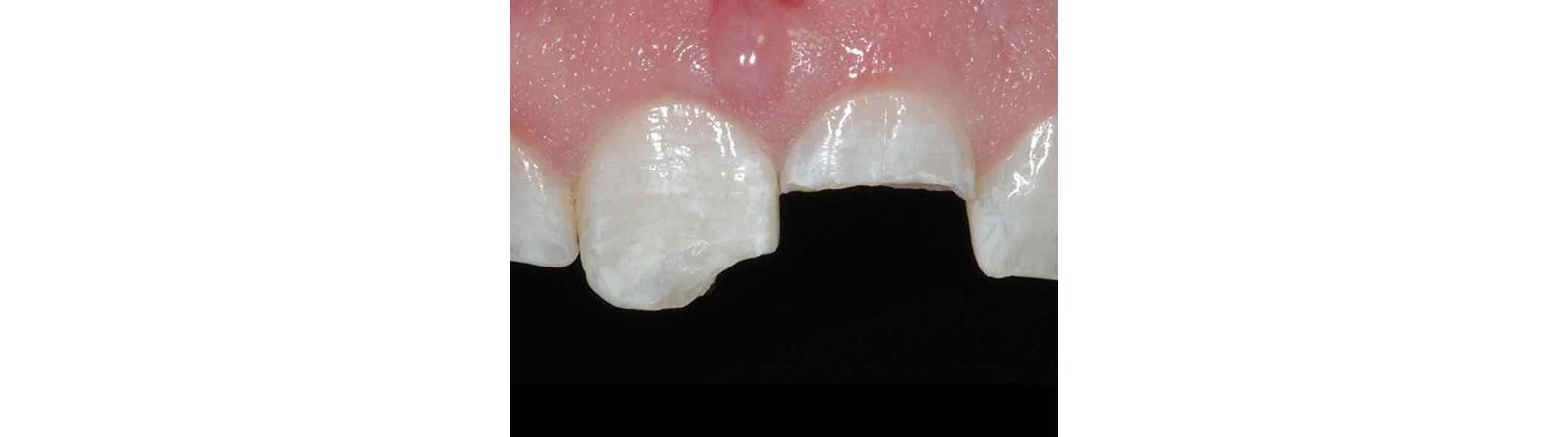Class IV fractures of the maxillary central incisors