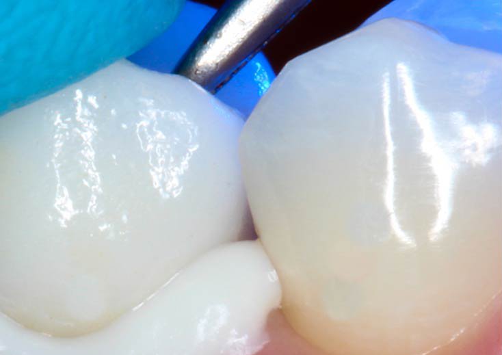 A small amount of cement should extrude during crown seating