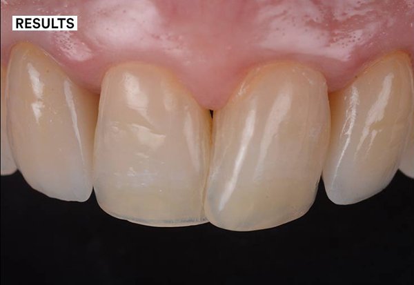 Two monolithic zirconia crowns in place