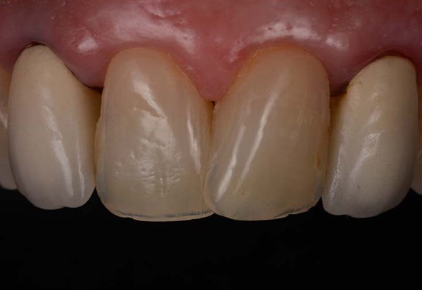 Metal-ceramic crowns on maxillary lateral incisors