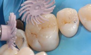 A high gloss polish was achieved using the 3M™ Sof-Lex™ Diamond Polishing Spiral