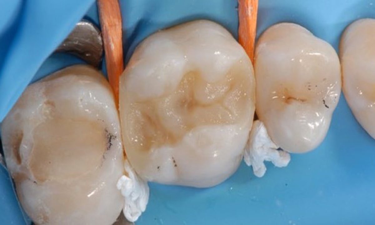 Incremental build-up of dentin layer with 3M™ Filtek™ Supreme XTE Universal Restorative