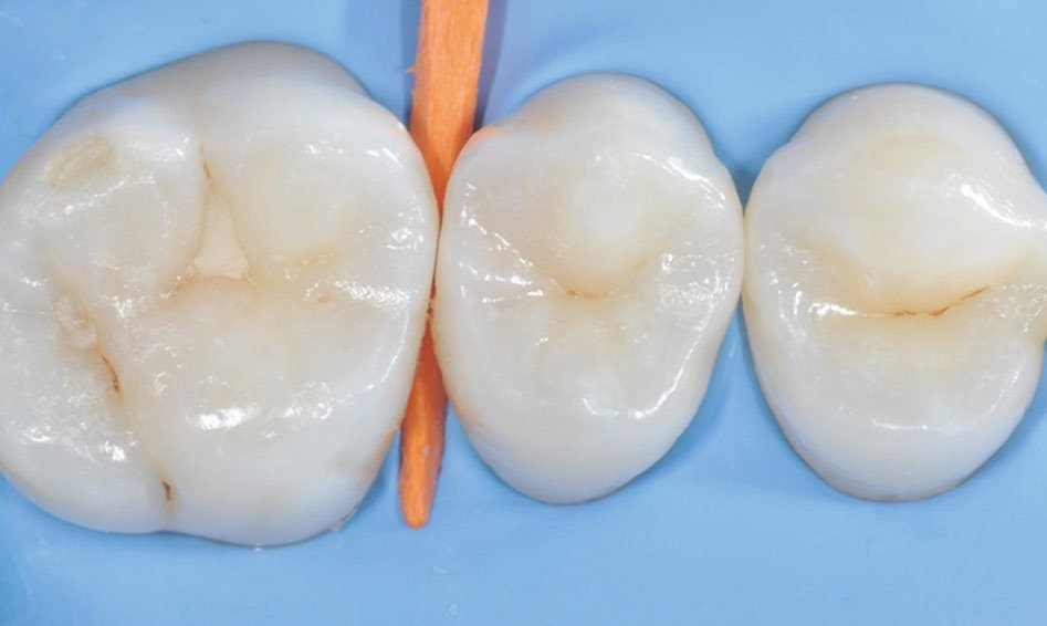 Insertion of a proximal wedge