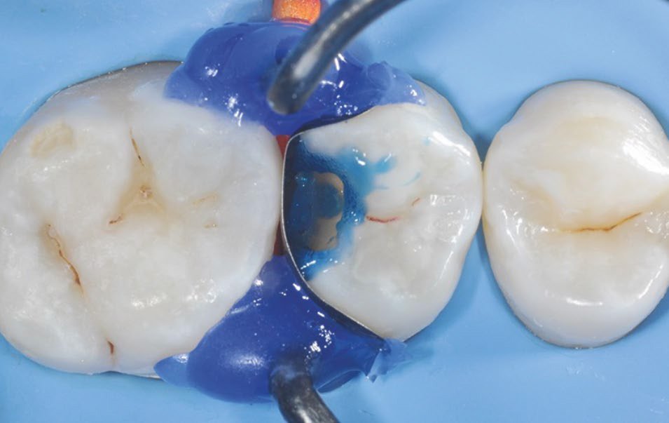 A 15 second selective enamel etch using 3M™ Scotchbond™ Universal Etchant