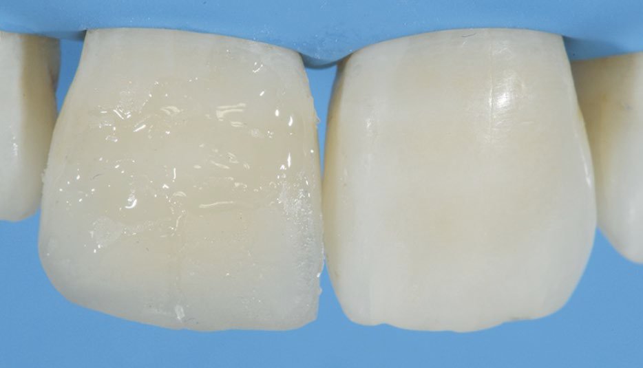 Placement of A3E shade of 3M™ Filtek™ Supreme XTE Universal Restorative