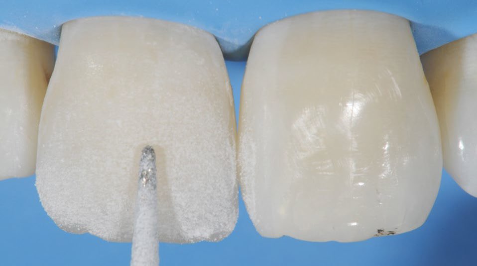 Smoothening the surface with a low-speed medium/coarse diamond bur