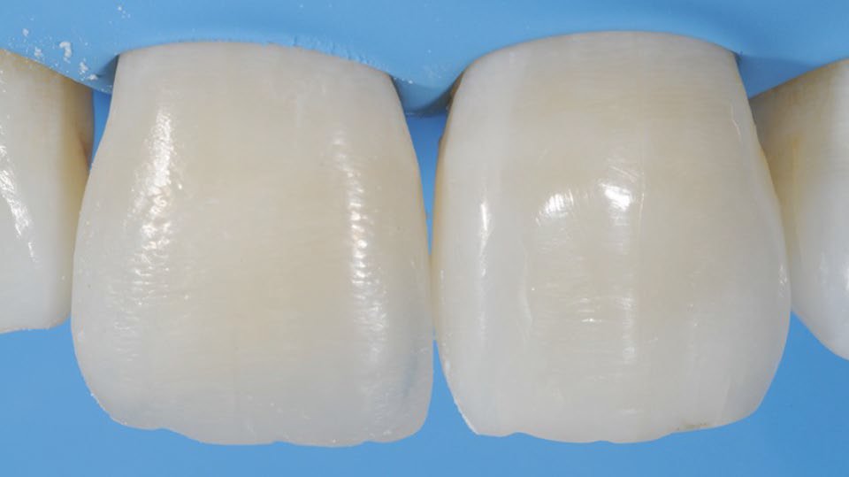 Final restoration immediately after finishing and polishing