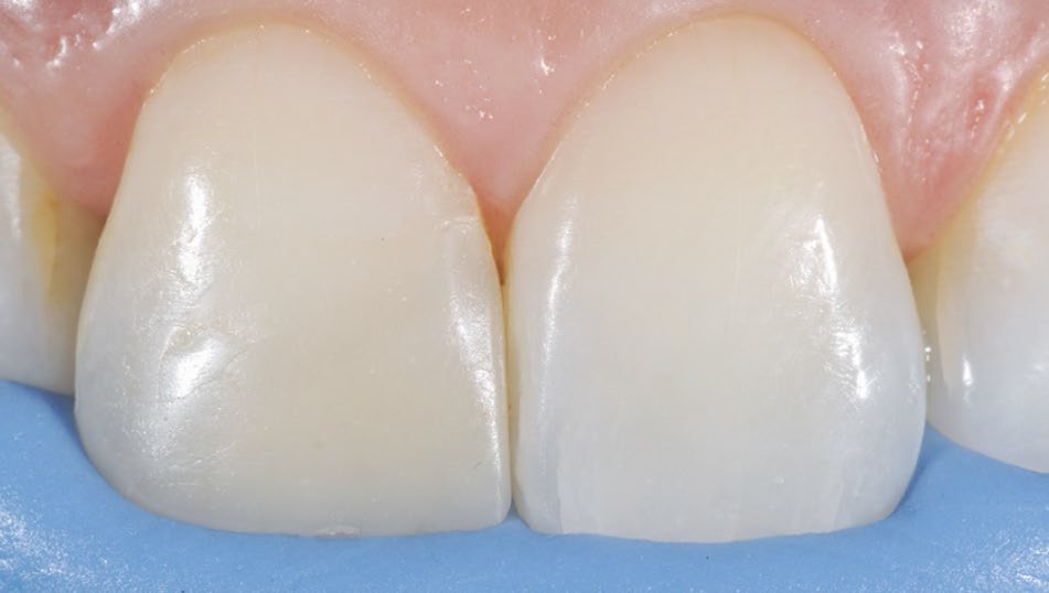 silicone impression material on tooth as guide