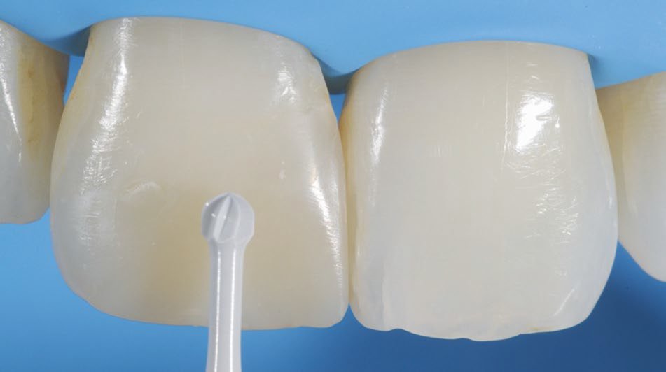 Taking of old restauration of the tooth with a ceramic bur