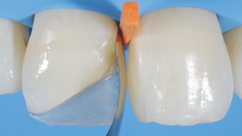 Sectional matrix placed cervico-incisally to give a round contour to the proximal wall between teeth.