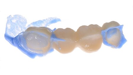 Assess the fit of a zirconia restoration