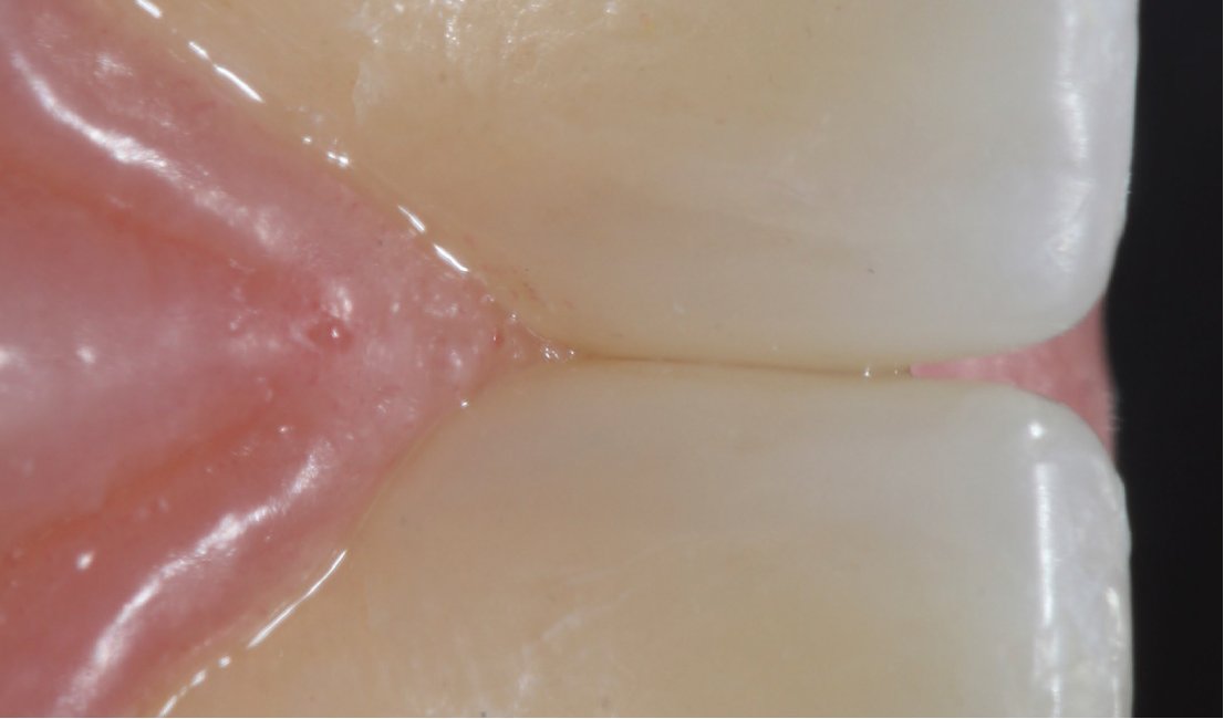 Palatal view of the restoration.
