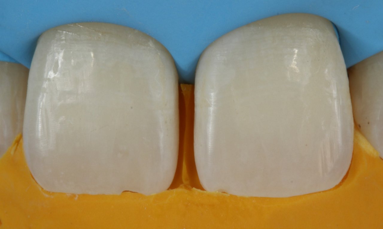 Teeth prophylaxis