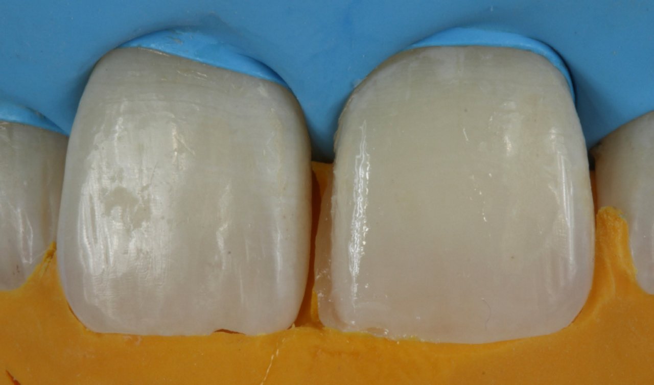 First layer of 3M™ Filtek™ Universal Restorative on teeth