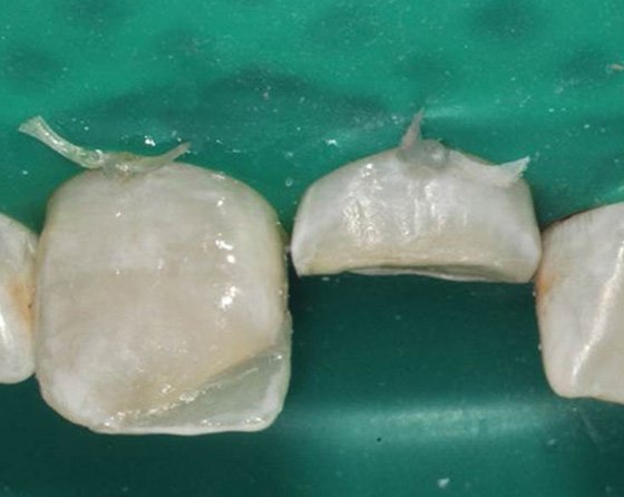 Created halo with white tint at the incisal edge of the lingual shell