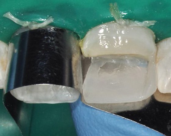 Created mesial contact, surface contours, and embrasure