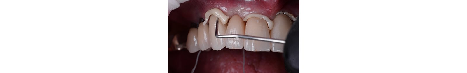  Excess removal
