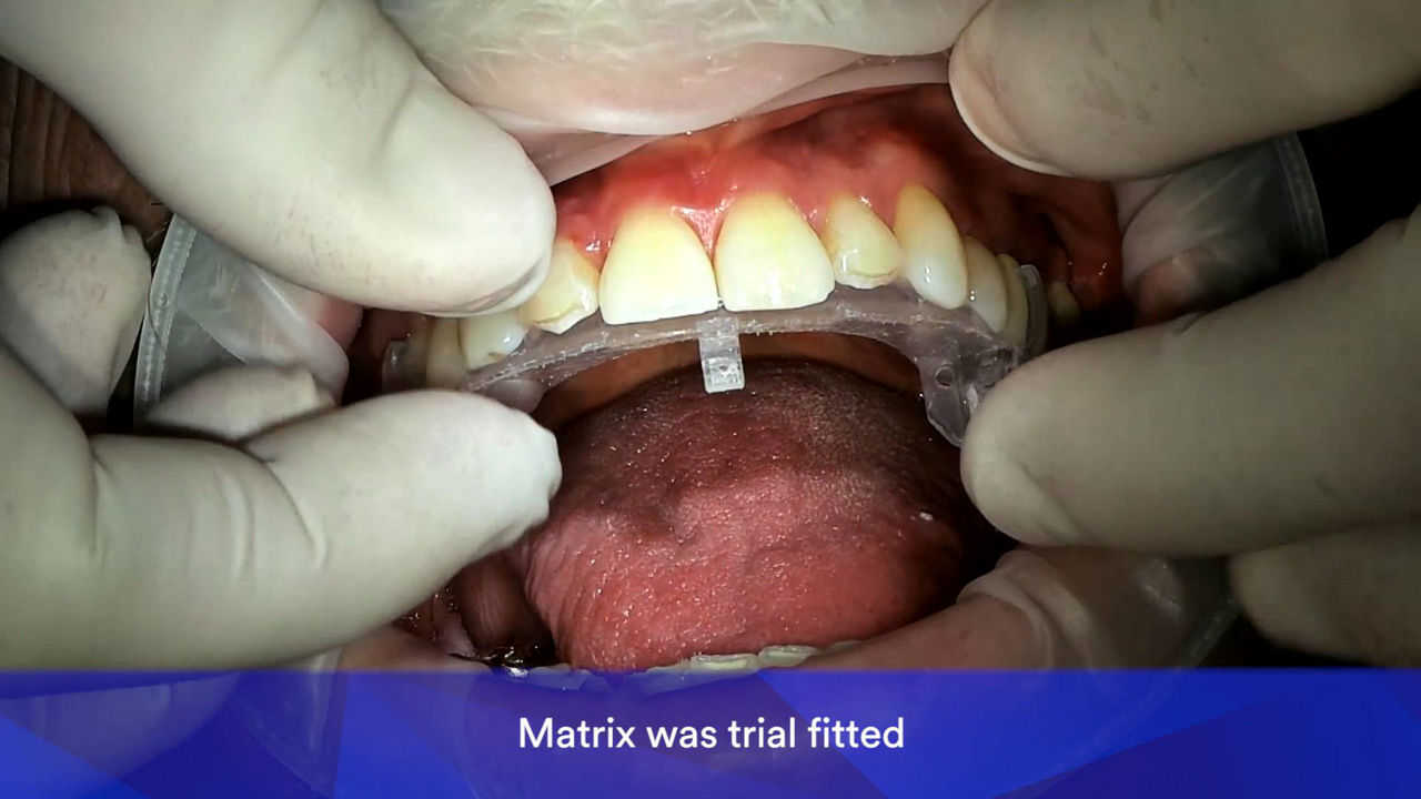 Dr-Hodges_6-unit-Veneer-Case-1.mp4
