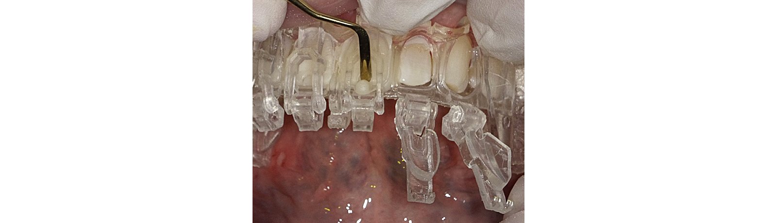 bite-wing radiograph