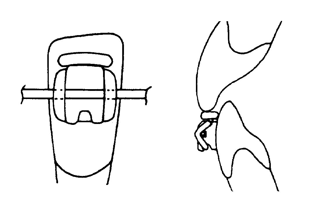 3M™ AlastiK™ Elastomeric Ligature with Guard