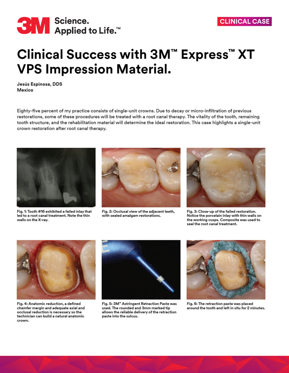 Clinical Case with a single-unit crown by Dr. Espinosa