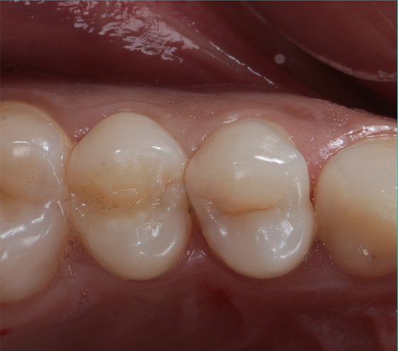 Initial situation (occlusal view)