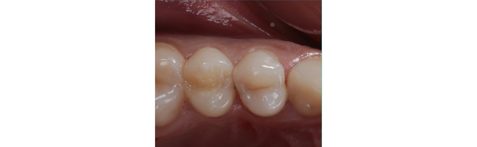 Initial situation (occlusal view)