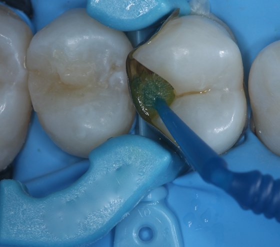 Application of adhesive on dentin